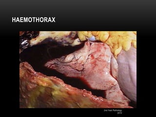 2nd Year Pathology
2010
HAEMOTHORAX
 