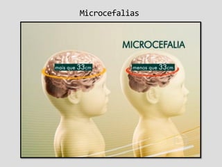 Microcefalias
 