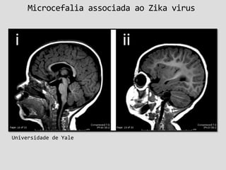 Microcefalia associada ao Zika virus
Universidade de Yale
 