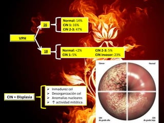 16

Normal: 14%
CIN 1: 16%
CIN 2-3: 47%

18

Normal: <2%
CIN 1: 5%

VPH

CIN = Displasia






Inmadurez cel
Desorganización cel
Anomalias nucleares
↑ actividad mitótica.

CIN 2-3: 5%
CIN invasor: 23%

 