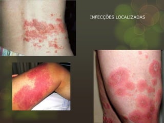 INFECÇÕES LOCALIZADAS
 