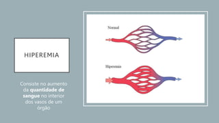 HIPEREMIA
Consiste no aumento
da quantidade de
sangue no interior
dos vasos de um
órgão
 