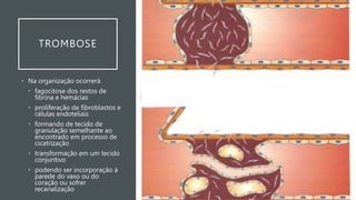 TROMBOSE
• Na organização ocorrerá
• fagocitose dos restos de
fibrina e hemácias
• proliferação de fibroblastos e
células endoteliais
• formando de tecido de
granulação semelhante ao
encontrado em processo de
cicatrização
• transformação em um tecido
conjuntivo
• podendo ser incorporação à
parede do vaso ou do
coração ou sofrer
recanalização
 