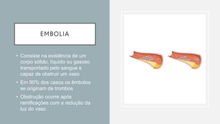EMBOLIA
• Consiste na existência de um
corpo sólido, líquido ou gasoso
transportado pelo sangue e
capaz de obstruir um vaso
• Em 90% dos casos os êmbolos
se originam de trombos
• Obstrução ocorre após
ramificações com a redução da
luz do vaso
 