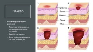 INFARTO
• Escaras (úlceras de
pressão)
• Podem ser originadas por
compressão dos vasos -
congestão
• Decúbito prolongado
• Pode evoluir para isquemia,
necrose e ulceração
 