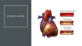 ATEROSCLEROSE
 
