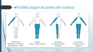 ●Parálisis según la parte del cuerpo;
 