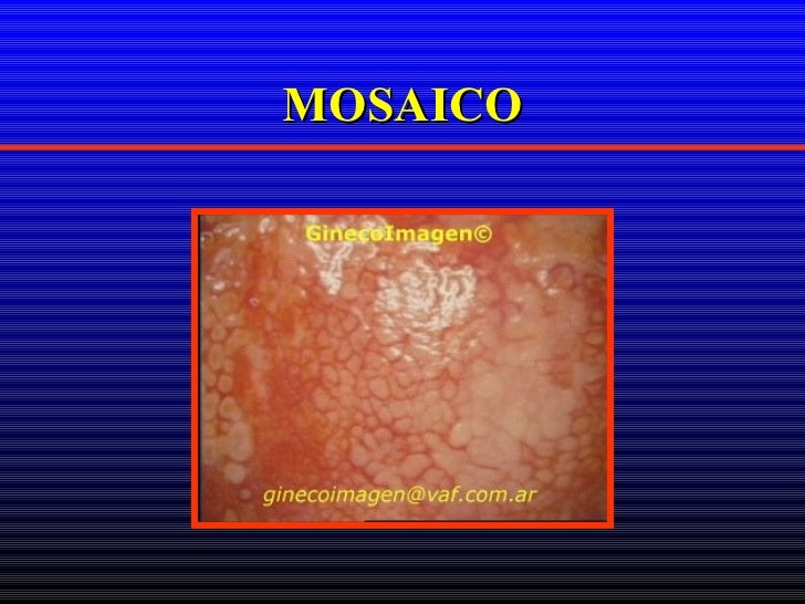 Flogosi Cronica Del Corion Colposcopia