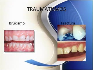 TRAUMATISMOSTRAUMATISMOS
Bruxismo Fractura
 