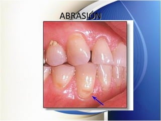 ABRASIÓNABRASIÓN
 