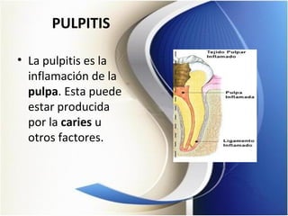 PULPITIS
• La pulpitis es la
inflamación de la
pulpa. Esta puede
estar producida
por la caries u
otros factores.
 