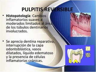 PULPITIS REVERSIBLE
• Histopatología: Cambios
inflamatorios suaves a
moderados limitados al área
de los túbulos dentinarios
involucrados.
• Se aprecia dentina reparativa,
interrupción de la capa
odontoblástica, vasos
dilatados, líquido edematoso
y la presencia de células
inflamatorias crónicas.
 