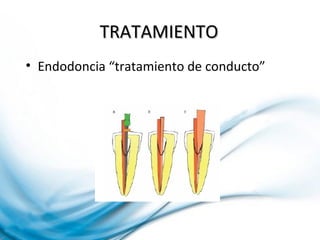 TRATAMIENTOTRATAMIENTO
• Endodoncia “tratamiento de conducto”
 