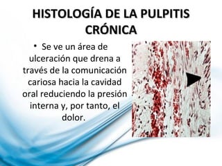HISTOLOGÍA DE LA PULPITISHISTOLOGÍA DE LA PULPITIS
CRÓNICACRÓNICA
• Se ve un área de
ulceración que drena a
través de la comunicación
cariosa hacia la cavidad
oral reduciendo la presión
interna y, por tanto, el
dolor.
 