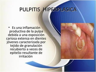PULPITIS HIPERPLASICAPULPITIS HIPERPLASICA
• Es una inflamación
productiva de la pulpa
debida a una exposición
cariosa extensa en dientes
jóvenes caracterizada por
tejido de granulación
recubierto a veces de
epitelio resultante de
irritación
 