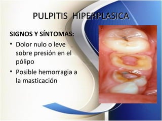 PULPITIS HIPERPLASICAPULPITIS HIPERPLASICA
SIGNOS Y SÍNTOMAS:
• Dolor nulo o leve
sobre presión en el
pólipo
• Posible hemorragia a
la masticación
 