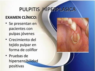 PULPITIS HIPERPLASICAPULPITIS HIPERPLASICA
EXAMEN CLÍNICO:
• Se presentan en
pacientes con
pulpas jóvenes
• Crecimiento del
tejido pulpar en
forma de coliflor
• Pruebas de
hipersensibilidad
positivas
 