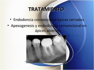 TRATAMIENTOTRATAMIENTO::
• Endodoncia convencional ápices cerrados
• Apexogenesis y endodoncia convencional en
ápices abiertos.
 