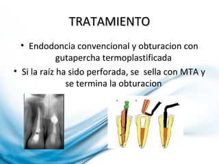 TRATAMIENTOTRATAMIENTO
• Endodoncia convencional y obturacion con
gutapercha termoplastificada
• Si la raíz ha sido perforada, se sella con MTA y
se termina la obturacion
 