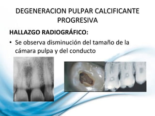 HALLAZGO RADIOGRÁFICO:
• Se observa disminución del tamaño de la
cámara pulpa y del conducto
DEGENERACION PULPAR CALCIFICANTEDEGENERACION PULPAR CALCIFICANTE
PROGRESIVAPROGRESIVA
 