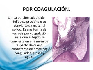 POR COAGULACIÓN.POR COAGULACIÓN.
1. La porción soluble del
tejido se precipita o se
convierte en material
sólido. Es una forma de
necrosis por coagulación
en la que el tejido se
convierte en una masa de
aspecto de queso
consistente de proteínas
coaguladas, grasas y
agua.
 