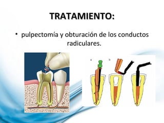 TRATAMIENTO:TRATAMIENTO:
• pulpectomía y obturación de los conductos
radiculares.
 