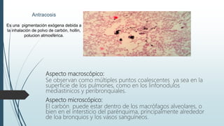 Antracosis
Es una pigmentación exógena debida a
la inhalación de polvo de carbón, hollin,
polucion atmosférica.
Aspecto macroscópico:
Se observan como múltiples puntos coalescentes ya sea en la
superficie de los pulmones, como en los linfonodulos
mediastinicos y peribronquiales.
Aspecto microscópico:
El carbón puede estar dentro de los macrófagos alveolares, o
bien en el intersticio del parénquima, principalmente alrededor
de loa bronquios y los vasos sanguíneos.
 