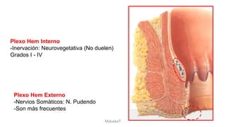 Plexo Hem Interno
-Inervación: Neurovegetativa (No duelen)
Grados I - IV
Plexo Hem Externo
-Nervios Somáticos: N. Pudendo
-Son más frecuentes
MyluskaT
 