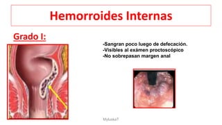 Hemorroides Internas
Grado I:
-Sangran poco luego de defecación.
-Visibles al exámen proctoscópico
-No sobrepasan margen anal
MyluskaT
 