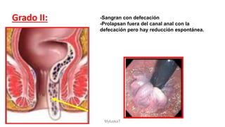 Grado II: -Sangran con defecación
-Prolapsan fuera del canal anal con la
defecación pero hay reducción espontánea.
MyluskaT
 