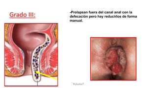 Grado III: -Prolapsan fuera del canal anal con la
defecación pero hay reducirlos de forma
manual.
MyluskaT
 