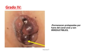 Grado IV:
-Permanecen prolapsadas por
fuera del canal anal y son
IRREDUCTIBLES.
MyluskaT
 