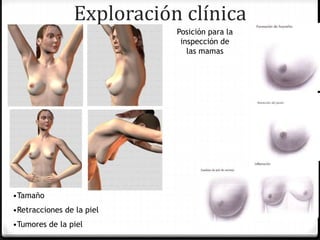 Exploración clínica
•Tamaño
•Retracciones de la piel
•Tumores de la piel
Posición para la
inspección de
las mamas
 