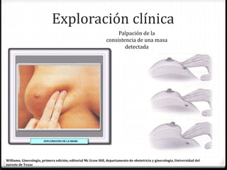 Exploración clínica
Palpación de la
consistencia de una masa
detectada
Williams, Ginecología, primera edición, editorial Mc Graw Hill, departamento de obstetricia y ginecología, Universidad del
sureste de Texas
 