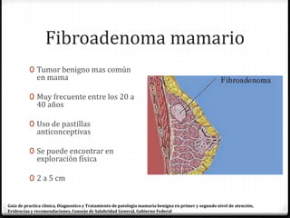 Fibroadenoma mamario
0 Tumor benigno mas común
en mama
0 Muy frecuente entre los 20 a
40 años
0 Uso de pastillas
anticonceptivas
0 Se puede encontrar en
exploración física
0 2 a 5 cm
Guía de practica clínica, Diagnostico y Tratamiento de patología mamaria benigna en primer y segundo nivel de atención,
Evidencias y recomendaciones, Consejo de Salubridad General, Gobierno Federal
 