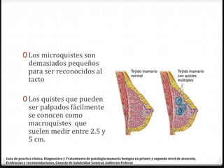 0 Los microquistes son
demasiados pequeños
para ser reconocidos al
tacto
0 Los quistes que pueden
ser palpados fácilmente
se conocen como
macroquistes que
suelen medir entre 2.5 y
5 cm.
Guía de practica clínica, Diagnostico y Tratamiento de patología mamaria benigna en primer y segundo nivel de atención,
Evidencias y recomendaciones, Consejo de Salubridad General, Gobierno Federal
 