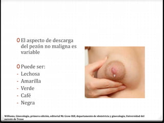 0 El aspecto de descarga
del pezón no maligna es
variable
0 Puede ser:
- Lechosa
- Amarilla
- Verde
- Café
- Negra
Williams, Ginecología, primera edición, editorial Mc Graw Hill, departamento de obstetricia y ginecología, Universidad del
sureste de Texas
 