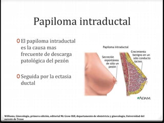 Papiloma intraductal
0 El papiloma intraductal
es la causa mas
frecuente de descarga
patológica del pezón
0 Seguida por la ectasia
ductal
Williams, Ginecología, primera edición, editorial Mc Graw Hill, departamento de obstetricia y ginecología, Universidad del
sureste de Texas
 