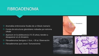 FIBROADENOMA
 Anomalías embrionarias focales de un lóbulo mamario
 Consta de estructuras glandulares rodeadas por estroma
celular
 Aparecen en la adolescencia (15-35 años), tienden a
desaparecer en el climaterio
 Fibroadenomas benignos (<3cm, <30 a): Observación
 Fibroadenomas que crecen: Tumorectomía
 
