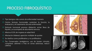PROCESO FIBROQUÍSTICO
 Tipo benigno más común de enfermedad mamaria
 Ciertos factores hormonales sustentan la función, la
evaluación y el tratamiento de esta enfermedad
 Estímulo hormonal provoca dilatación acinar llena de
líquido y se acompaña de abundante estroma
 Afecta al 52% de mujeres en edad fértil
 Afectación bilateral, aparición múltiple de quistes
 Se clasifica como proliferativo y no proliferativo
 Tto: Conservador (analgésicos, uso de brasier cómodo,
compresas calientes o frías en zonas dolorosas, reducir
cafeína)
 
