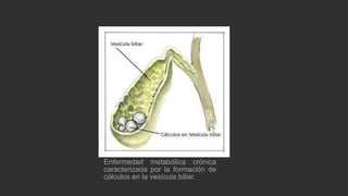 Enfermedad metabólica crónica
caracterizada por la formación de
cálculos en la vesícula biliar.

 