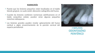 FIBROMA
ODONTOGÉNO
PERIFÉRICO
RADIOLOGÍA
▪ Puesto que las lesiones pequeñas están localizadas en el tejido
blando gingival, no suele existir alteración radiográfica del hueso.
▪ Cuando las lesiones contienen numerosas calcificaciones en el
tejido conjuntivo celular, pueden verse algunas pequeñas
manchas radioopacas.
▪ Las lesiones grandes pueden revelar aplanamiento del hueso
cortical o algún ensanchamiento de la porción cervical del
espacio periodontal.
 