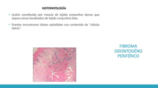 FIBROMA
ODONTOGÉNO
PERIFÉRICO
HISTOPATOLOGÍA
▪ Lesión constituida por mezcla de tejido conjuntivo denso que
separa zonas localizadas de tejido conjuntivo laxo.
▪ Pueden encontrarse islotes epiteliales con contenido de “células
claras”.
 