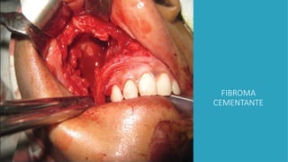 FIBROMA
CEMENTANTE
 