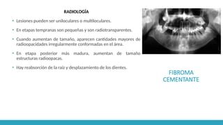 FIBROMA
CEMENTANTE
RADIOLOGÍA
▪ Lesiones pueden ser uniloculares o multiloculares.
▪ En etapas tempranas son pequeñas y son radiotransparentes.
▪ Cuando aumentan de tamaño, aparecen cantidades mayores de
radioopacidades irregularmente conformadas en el área.
▪ En etapa posterior más madura, aumentan de tamaño
estructuras radioopacas.
▪ Hay reabsorción de la raíz y desplazamiento de los dientes.
 