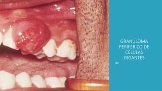 101
GRANULOMA
PERIFÉRICO DE
CÉLULAS
GIGANTES
 