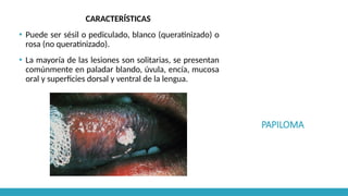 PAPILOMA
CARACTERÍSTICAS
▪ Puede ser sésil o pediculado, blanco (queratinizado) o
rosa (no queratinizado).
▪ La mayoría de las lesiones son solitarias, se presentan
comúnmente en paladar blando, úvula, encía, mucosa
oral y superficies dorsal y ventral de la lengua.
 