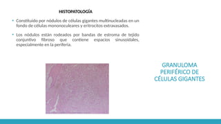 GRANULOMA
PERIFÉRICO DE
CÉLULAS GIGANTES
HISTOPATOLOGÍA
▪ Constituido por nódulos de células gigantes multinucleadas en un
fondo de células mononoculeares y eritrocitos extravasados.
▪ Los nódulos están rodeados por bandas de estroma de tejido
conjuntivo fibroso que contiene espacios sinusoidales,
especialmente en la periferia.
 