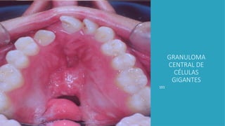 101
GRANULOMA
CENTRAL DE
CÉLULAS
GIGANTES
 