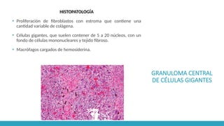 GRANULOMA CENTRAL
DE CÉLULAS GIGANTES
HISTOPATOLOGÍA
▪ Proliferación de fibroblastos con estroma que contiene una
cantidad variable de colágena.
▪ Células gigantes, que suelen contener de 5 a 20 núcleos, con un
fondo de células mononucleares y tejido fibroso.
▪ Macrófagos cargados de hemosiderina.
 